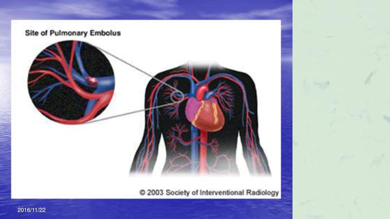 肺栓塞治疗与护理课件.ppt_第2页