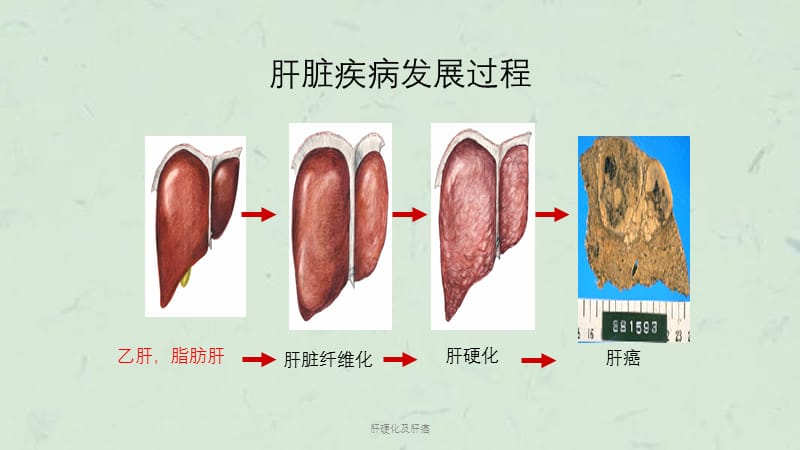 肝硬化及肝癌课件.pptx_第3页