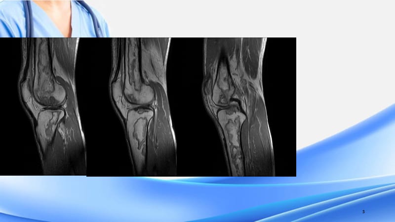 骨梗死影像诊断读片6（精选干货）.ppt_第3页