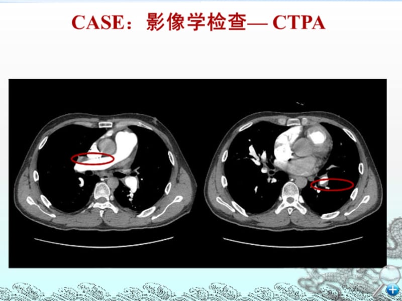 肺动脉高压的诊断与临床分类.ppt_第3页