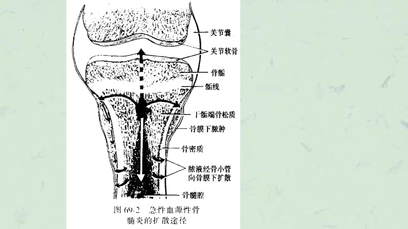 骨髓炎和结核课件.ppt_第2页