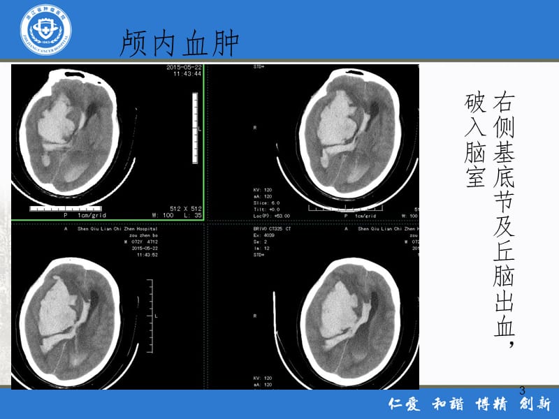 危急值---CTPPT演示课件.ppt_第3页