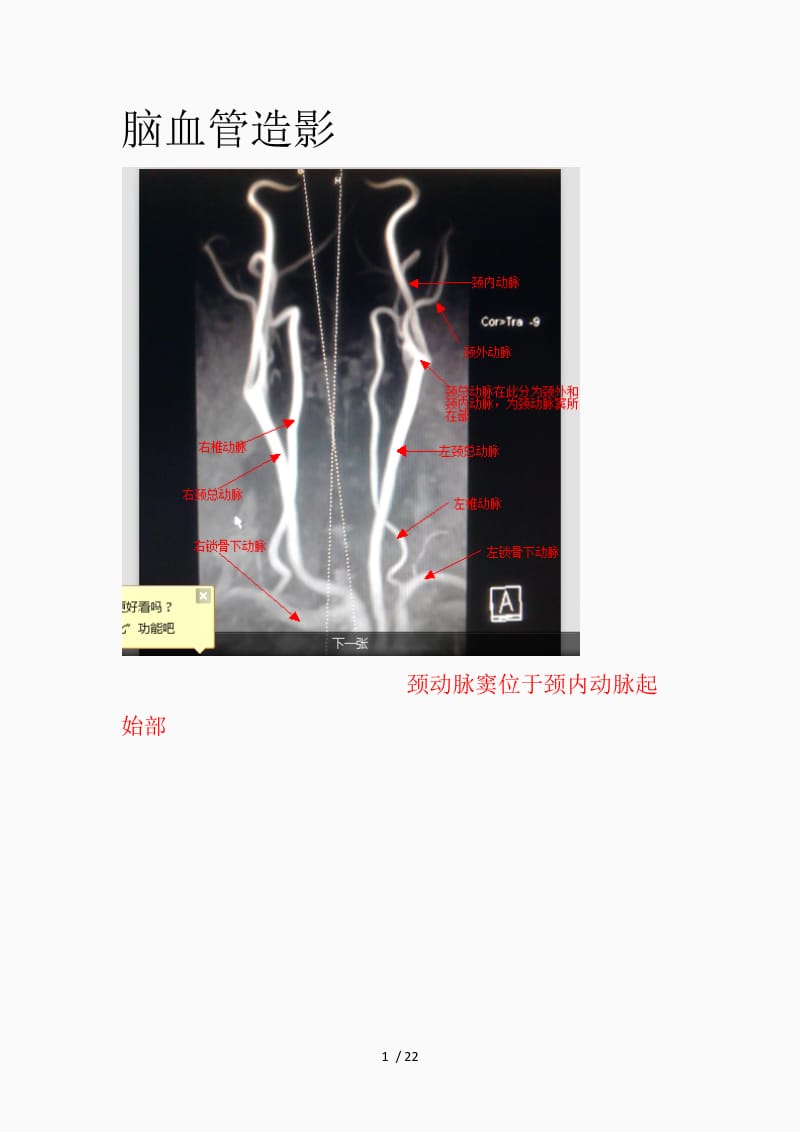 脑血管造影图片详解（精品课件）.docx_第1页