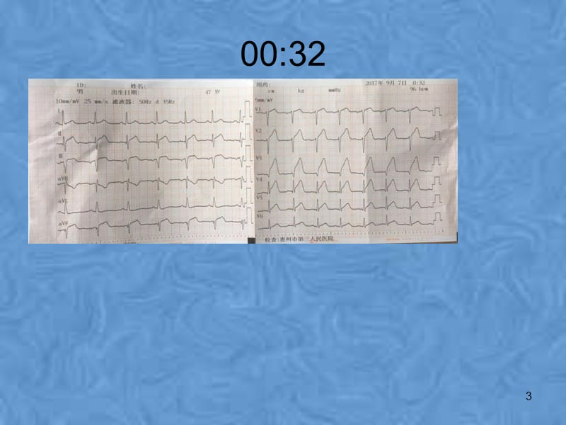 胸痛典型病例分析PPT课件.pptx_第3页