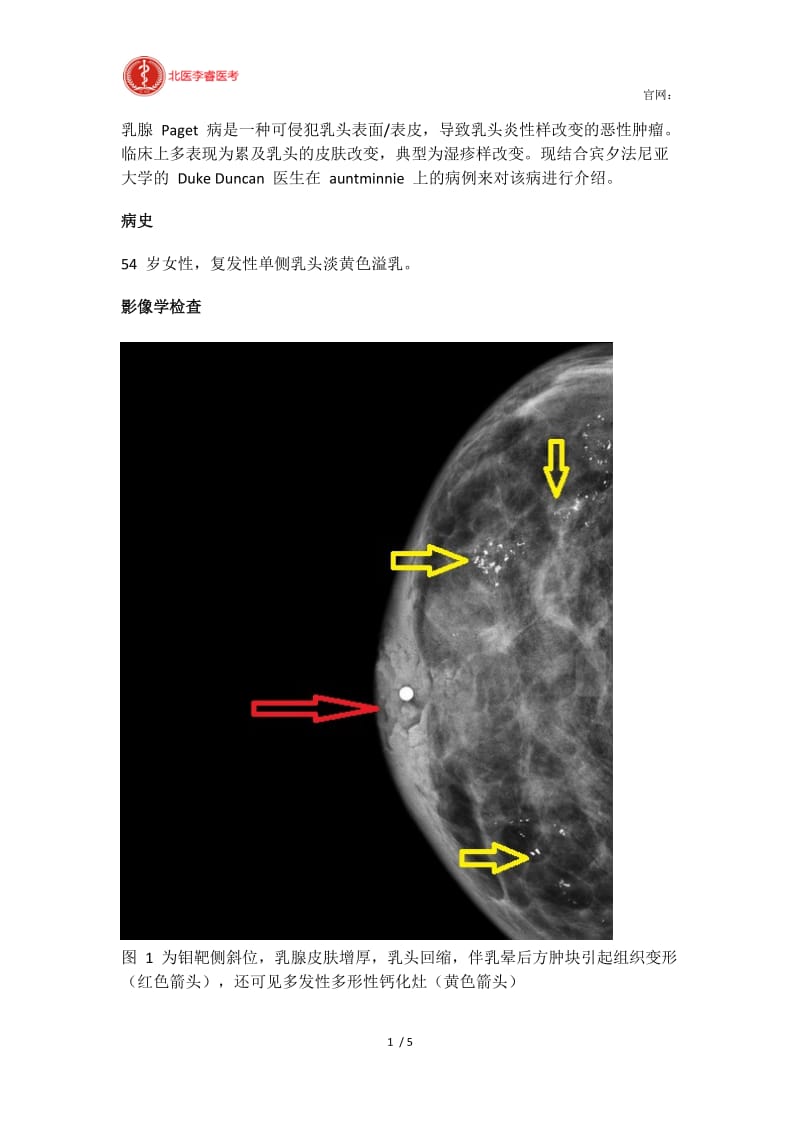 【最新】典型病例乳腺Paget病诊断要点.docx_第1页