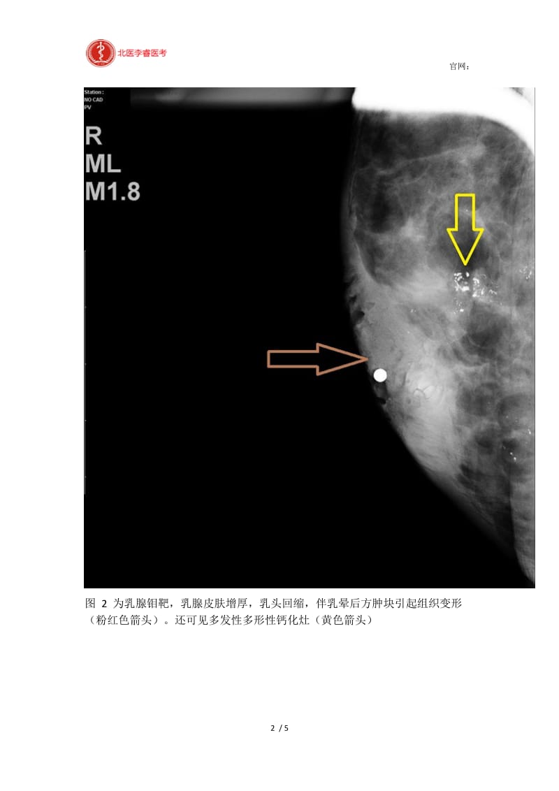 【最新】典型病例乳腺Paget病诊断要点.docx_第2页