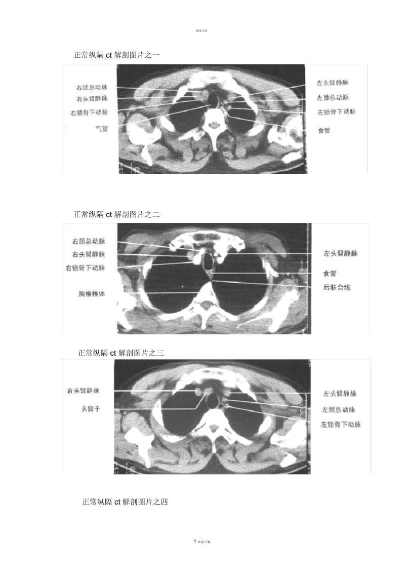 正常纵隔ct解剖图片之一.docx_第1页