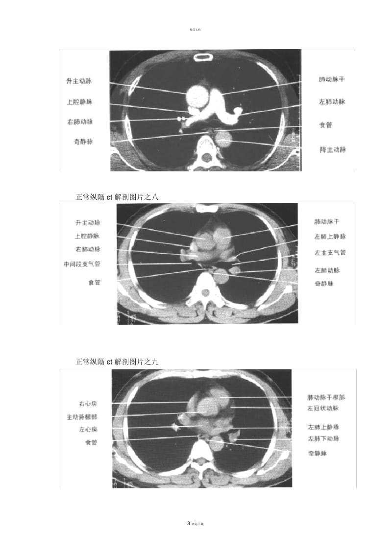 正常纵隔ct解剖图片之一.docx_第3页