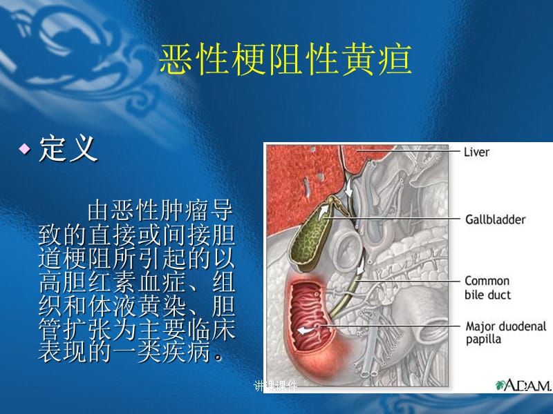 恶性梗阻性黄疸[行业特制].ppt_第2页