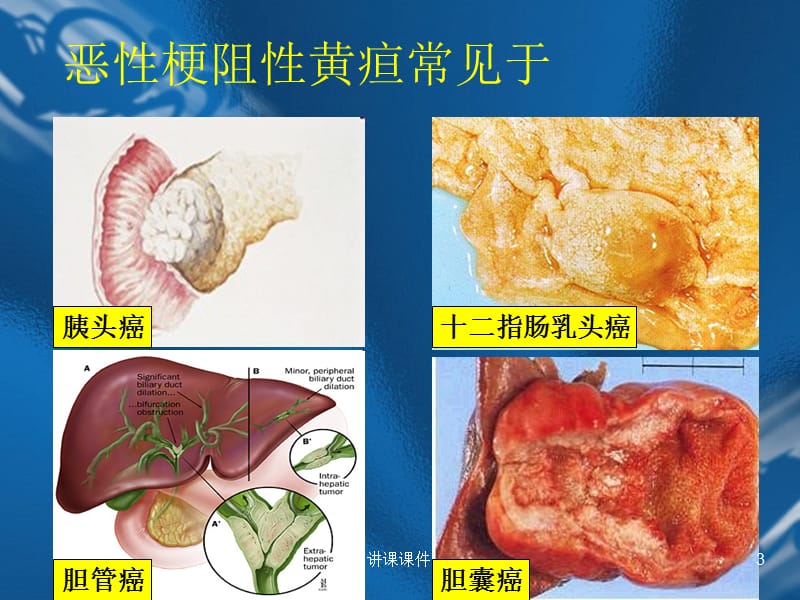 恶性梗阻性黄疸[行业特制].ppt_第3页