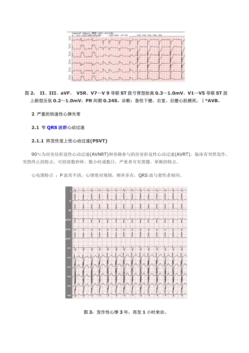 心电图危急值的识别与诊断.doc_第2页