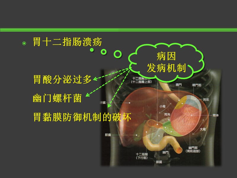 胃十二指肠溃疡外科治疗病人的护理精要.ppt_第2页