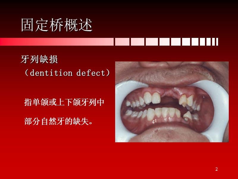 （推荐）固定桥概述、组成和类型.ppt_第2页