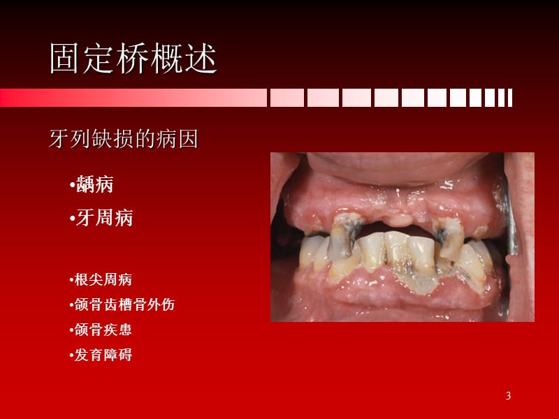 （推荐）固定桥概述、组成和类型.ppt_第3页