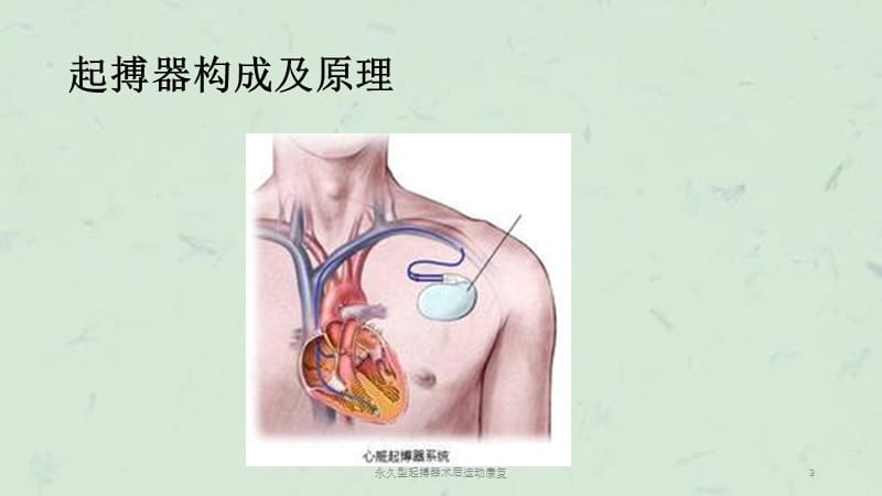 永久型起搏器术后运动康复课件.ppt_第3页