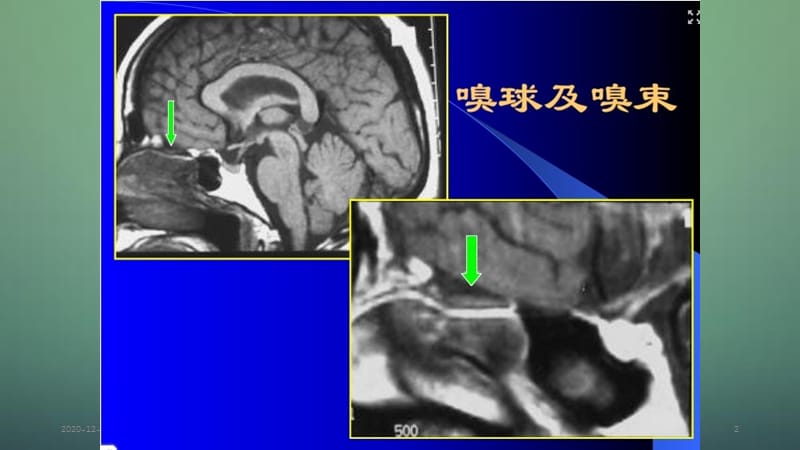 各条颅神经清晰MRI影像.ppt_第2页