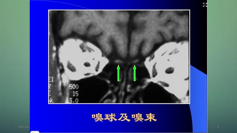 各条颅神经清晰MRI影像.ppt_第3页