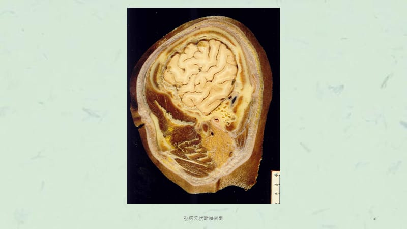 颅脑矢状断层解剖课件.ppt_第3页