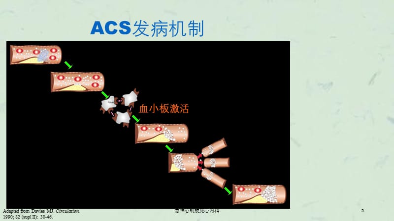 急性心肌梗死心内科课件.ppt_第3页