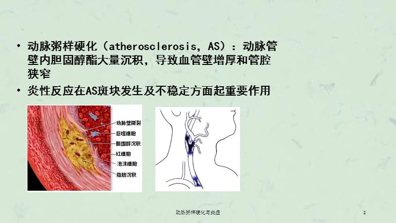 动脉粥样硬化与炎症课件.ppt_第2页