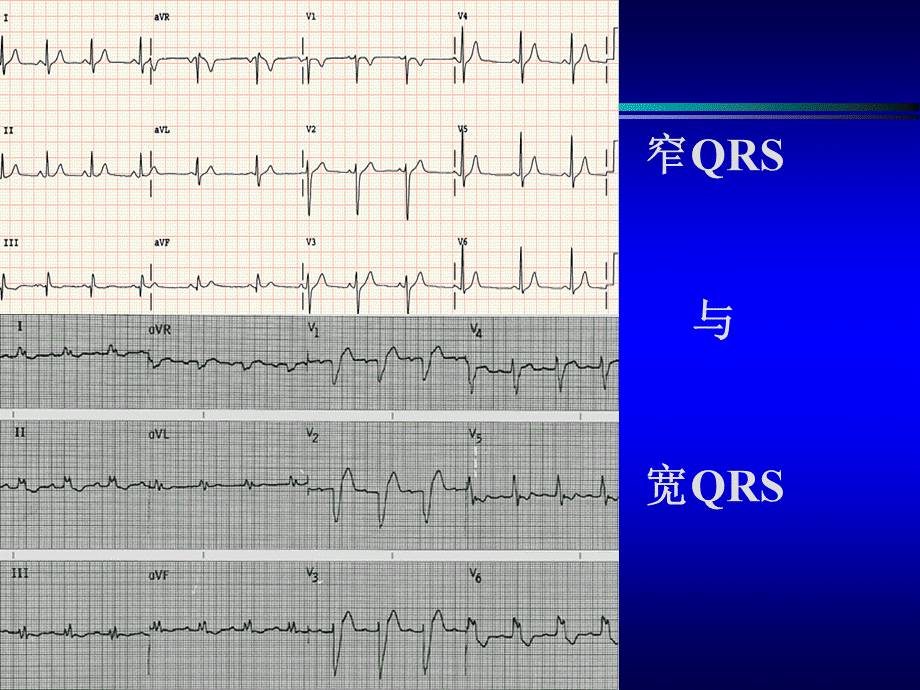 宽qrs心动过速的鉴别诊断（完整版修改） .ppt_第3页