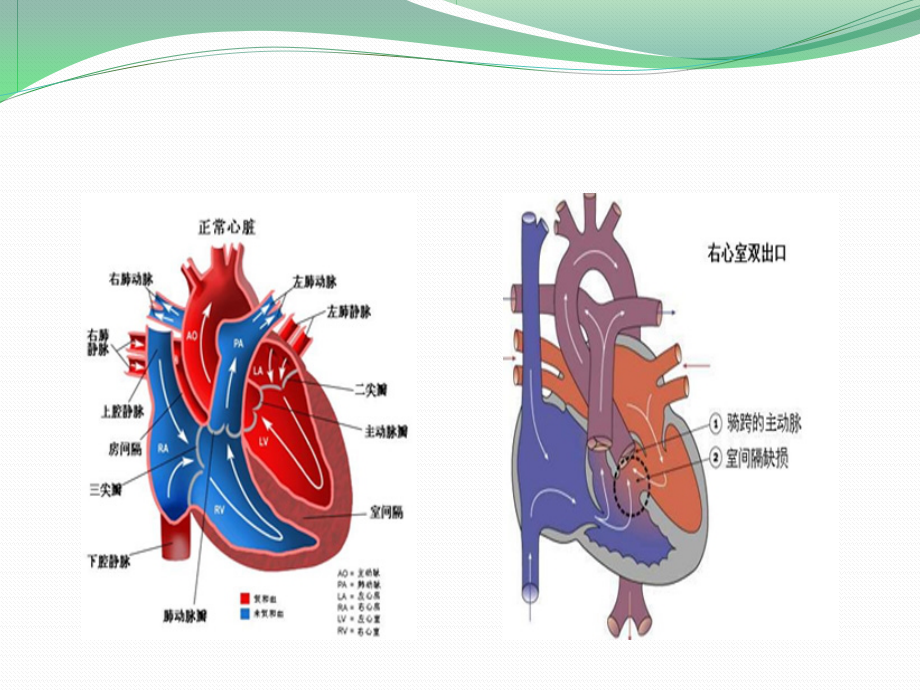 右室双出口.ppt_第3页