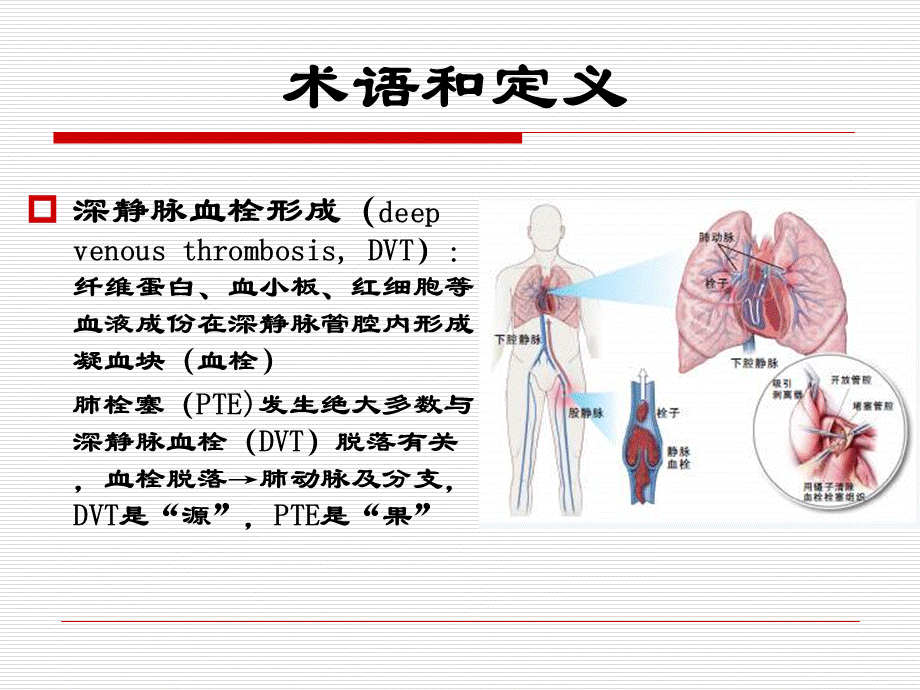 康复患者下肢静脉血栓防治.ppt_第2页