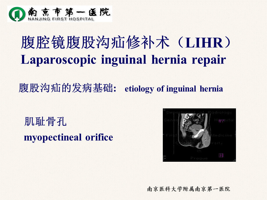 腹腔镜腹股沟疝修补术.ppt.ppt_第2页