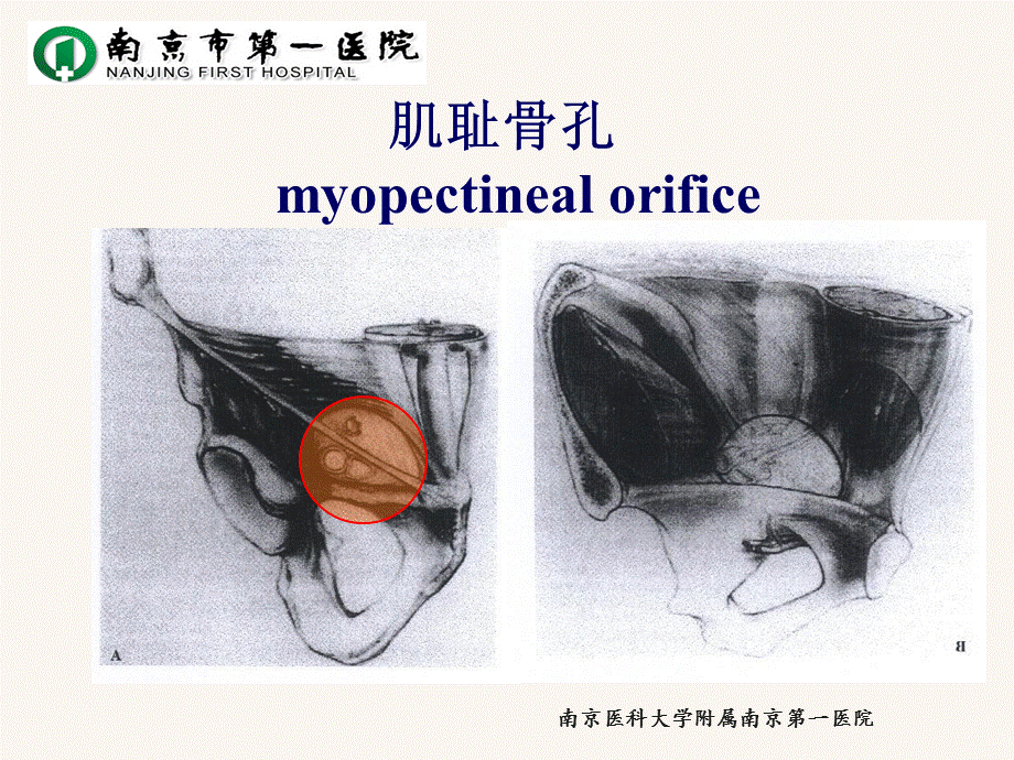 腹腔镜腹股沟疝修补术.ppt.ppt_第3页