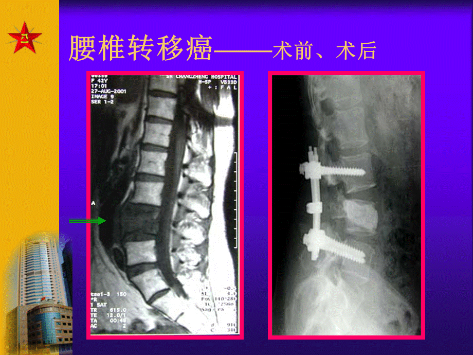 骨肿瘤.ppt.ppt_第3页