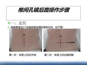 椎间孔镜后路操作步骤【ppt】 .ppt