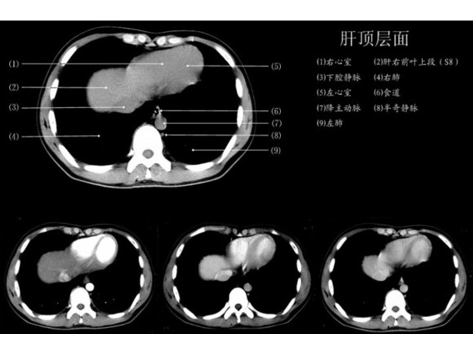 上腹部各层面CT.ppt_第2页