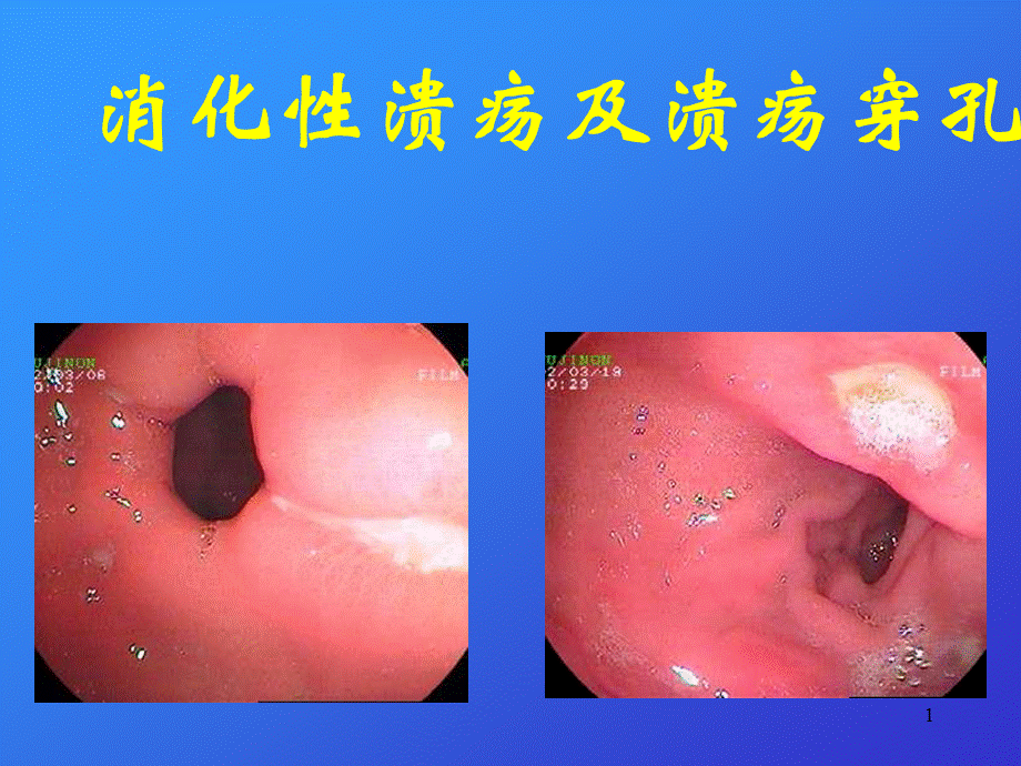 消化性溃疡08905.ppt_第1页