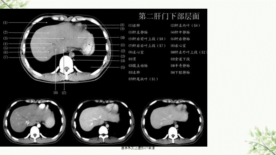 医学系列上腹部CT图谱课件.ppt_第3页