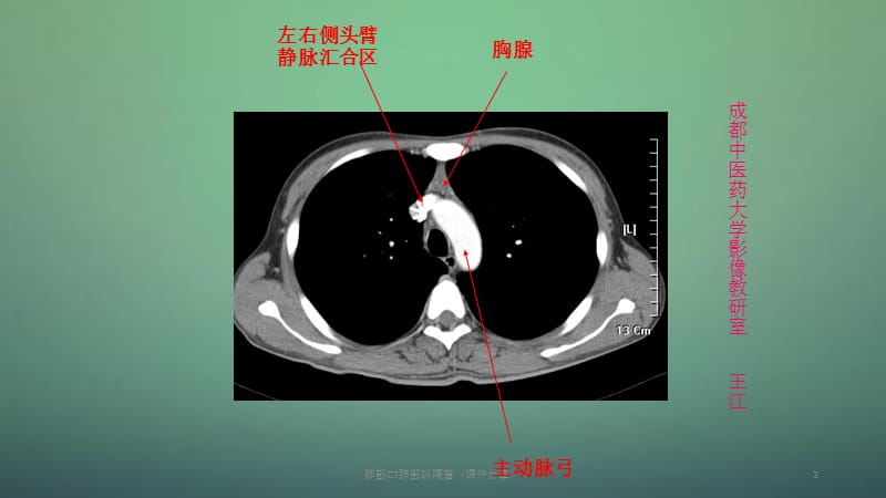 肺部CT肺部纵隔窗（课件分享）.ppt_第3页