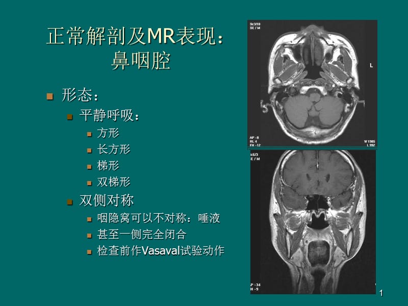 鼻咽癌MR诊断2018.ppt_第1页