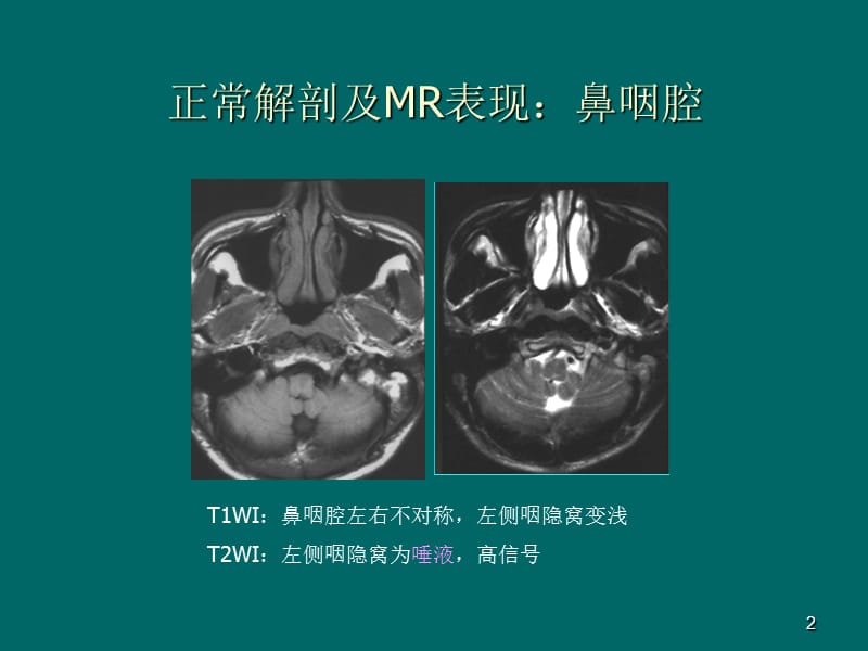 鼻咽癌MR诊断2018.ppt_第2页