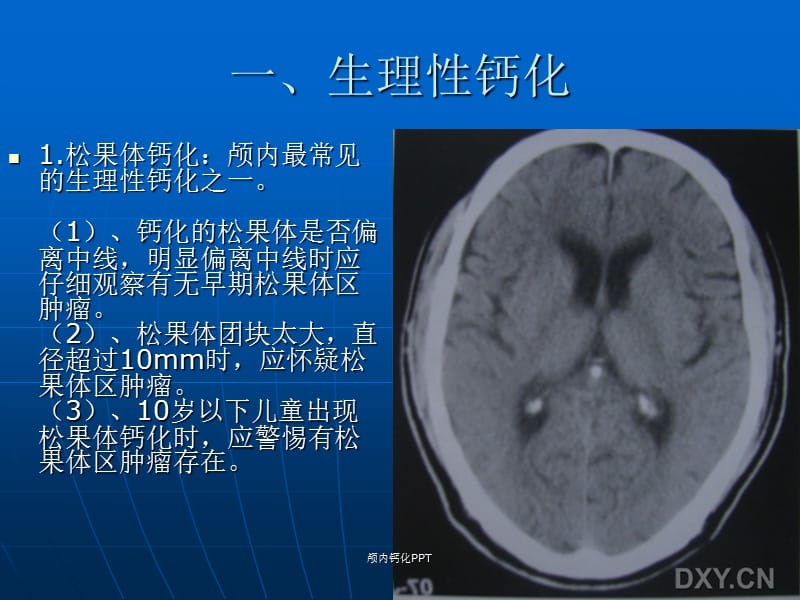 颅内钙化PPT.ppt_第2页