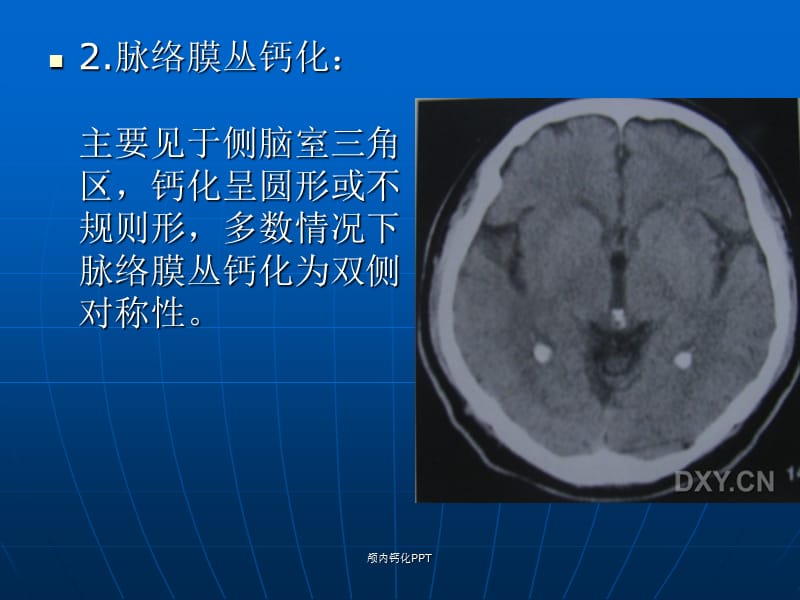 颅内钙化PPT.ppt_第3页