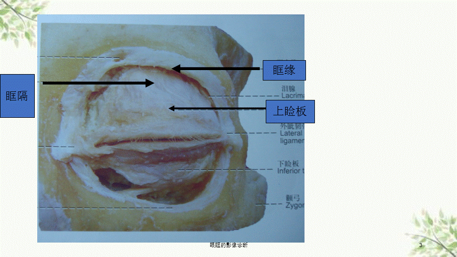 眼眶的影像诊断课件.ppt_第3页