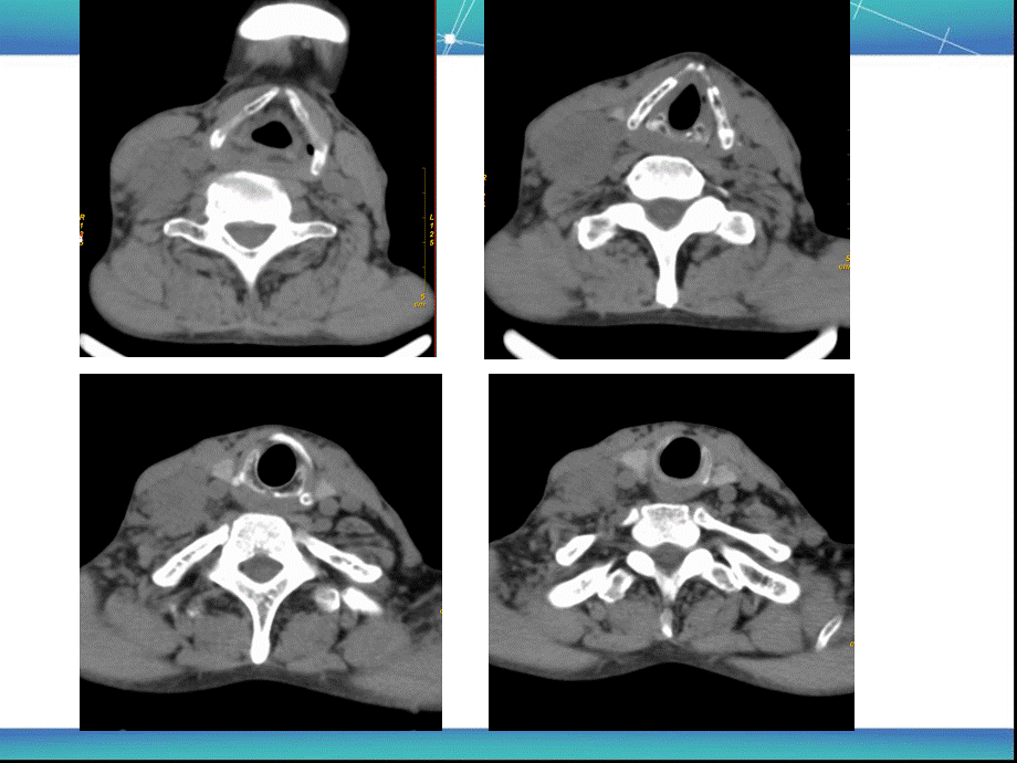 颈部病变疑难病例讨论.ppt_第3页