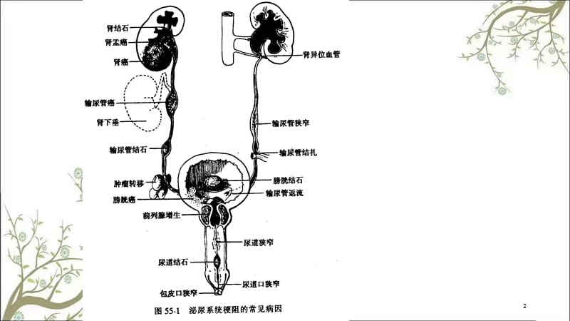 泌尿系梗阻课件.ppt_第2页