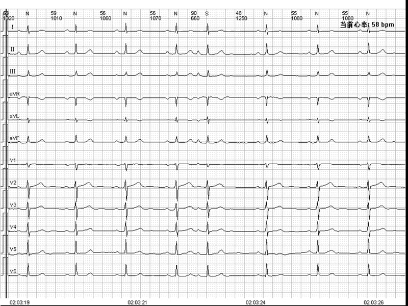 心电图常见波形及诊断（经典实用）.ppt_第2页