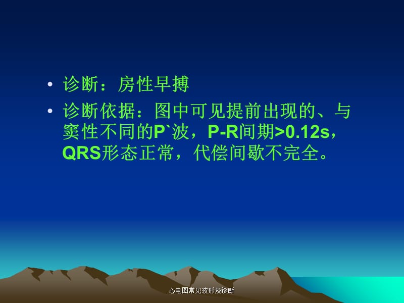 心电图常见波形及诊断（经典实用）.ppt_第3页