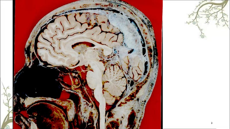 颅脑失状断层解剖课件.ppt_第3页