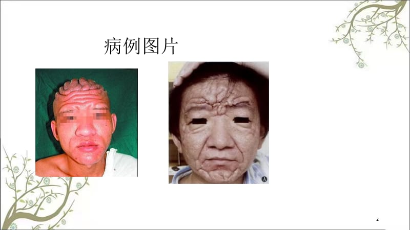 骨膜增生厚皮症课件.ppt_第2页