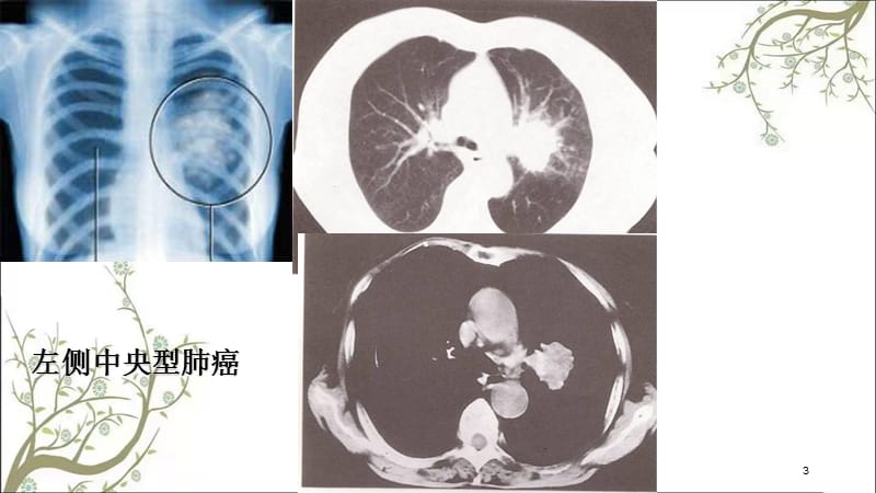 肺癌临概课件.ppt_第3页