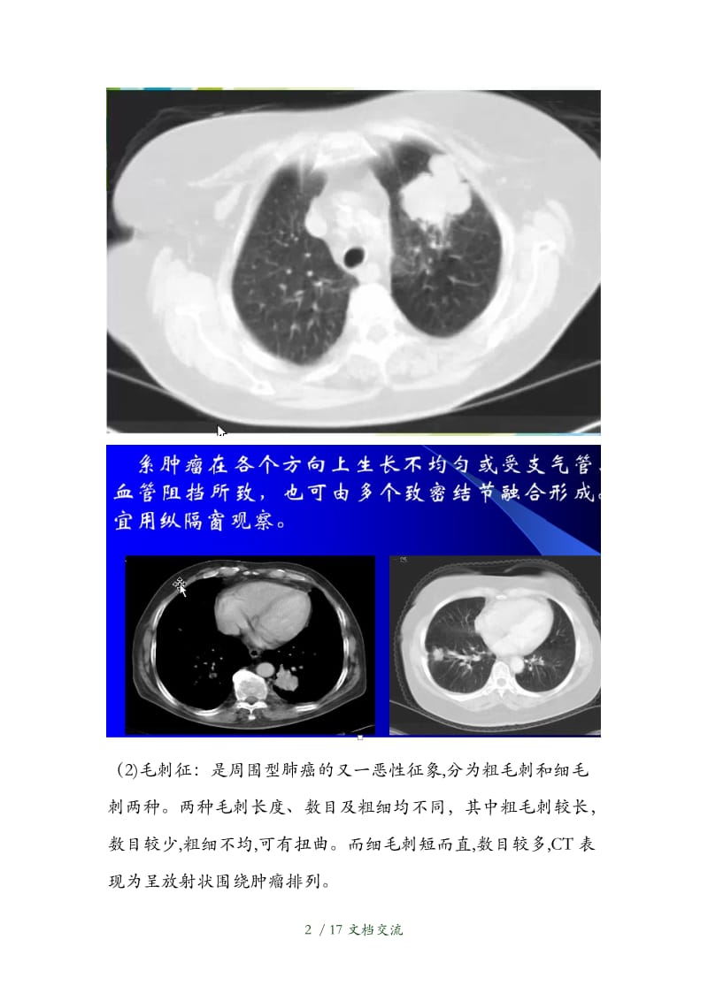 周围型肺癌的CT诊断与鉴别诊断分析（干货分享）.doc_第2页