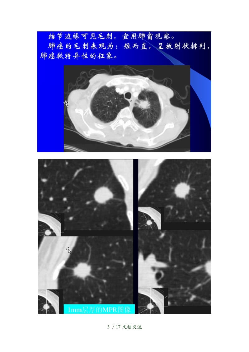 周围型肺癌的CT诊断与鉴别诊断分析（干货分享）.doc_第3页