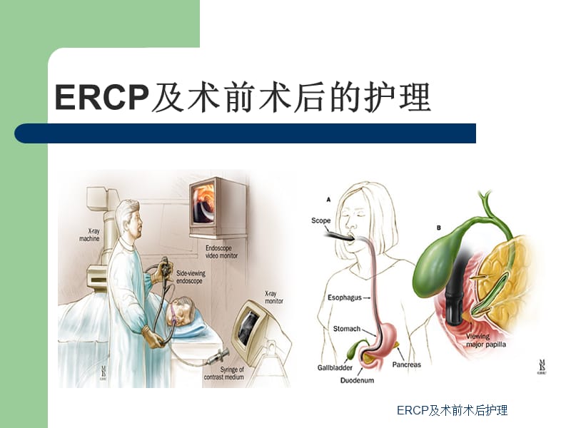 最新ERCP及术前术后护理.ppt_第1页